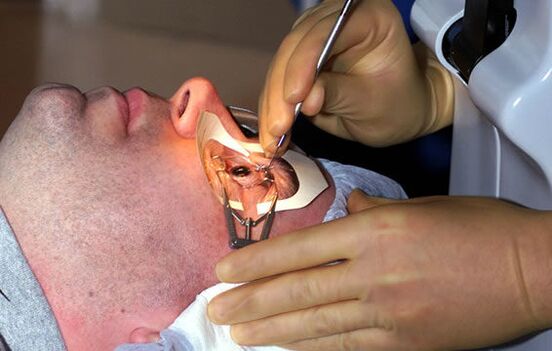 Skleroplastika pro krátkozrakost ke stabilizaci zraku