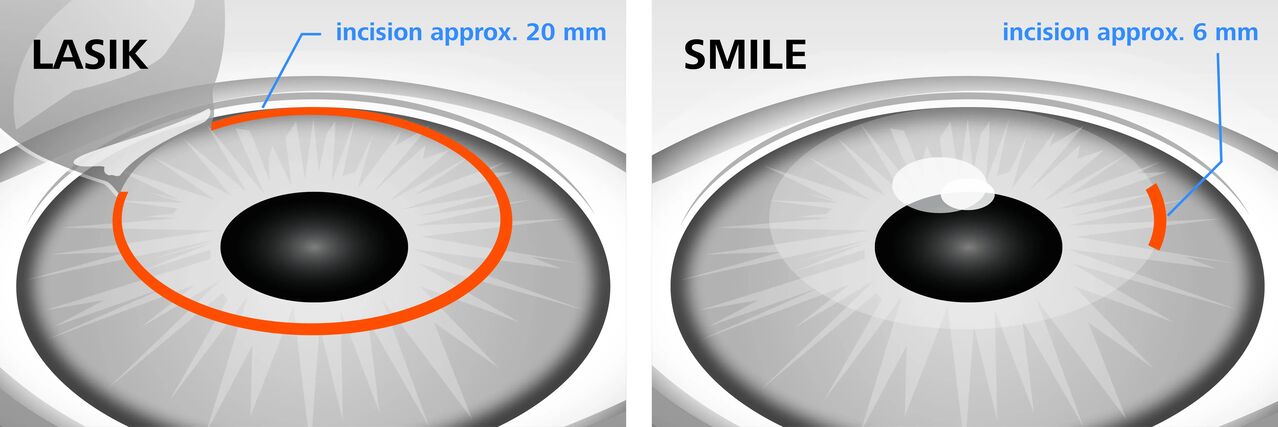 Srovnání laserových metod korekce zraku LASIK a SMILE